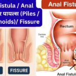 पोतो (Fistula / Anal Fistula) र पायल्स (Piles / Hemorrhoids)/ फिसर Fissure