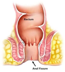 पोतो (Fistula / Anal Fistula) र पायल्स (Piles / Hemorrhoids)/ फिसर Fissure