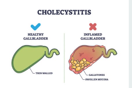 पित्तथैली जोगाउन अपनाउनुपर्ने प्राकृतिक आहार र बानीहरू